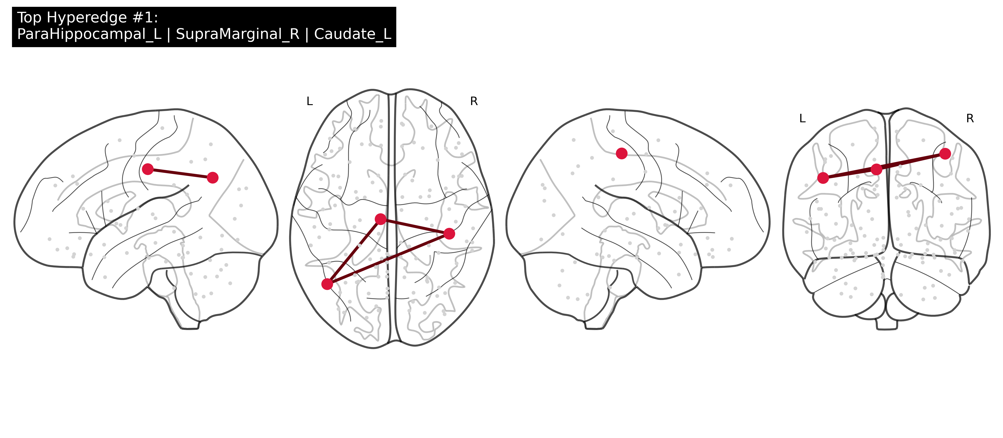 ASD Brain Hypergraph